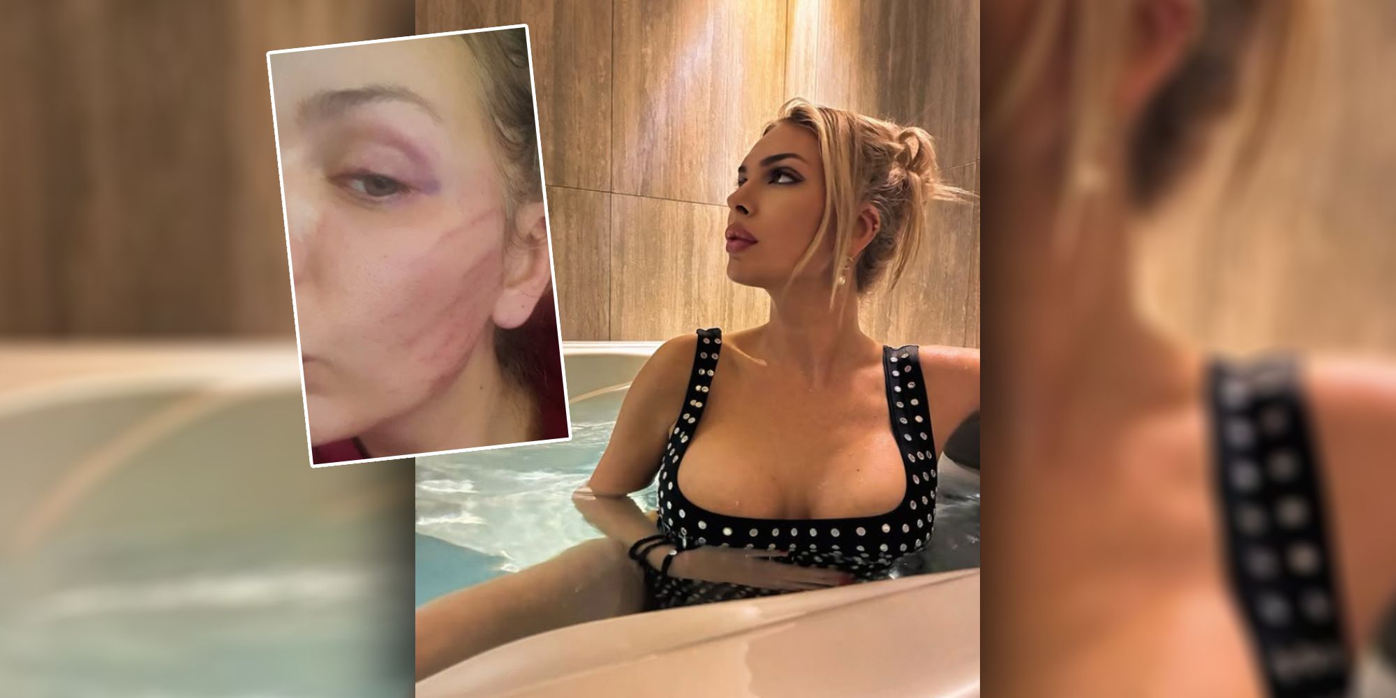 Ava zeigt ihre Verletzungen auf Insta.