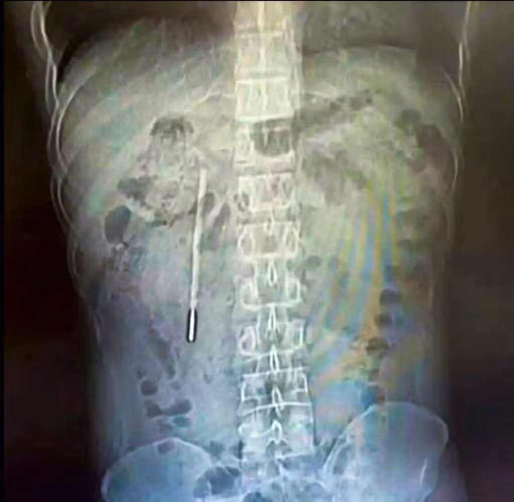 Heute.at - Ärzte untersuchen 32-Jährigen – heftig, was sie finden