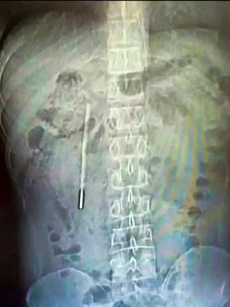 Mann lebte 20 Jahre lang mit Thermometer im Bauch