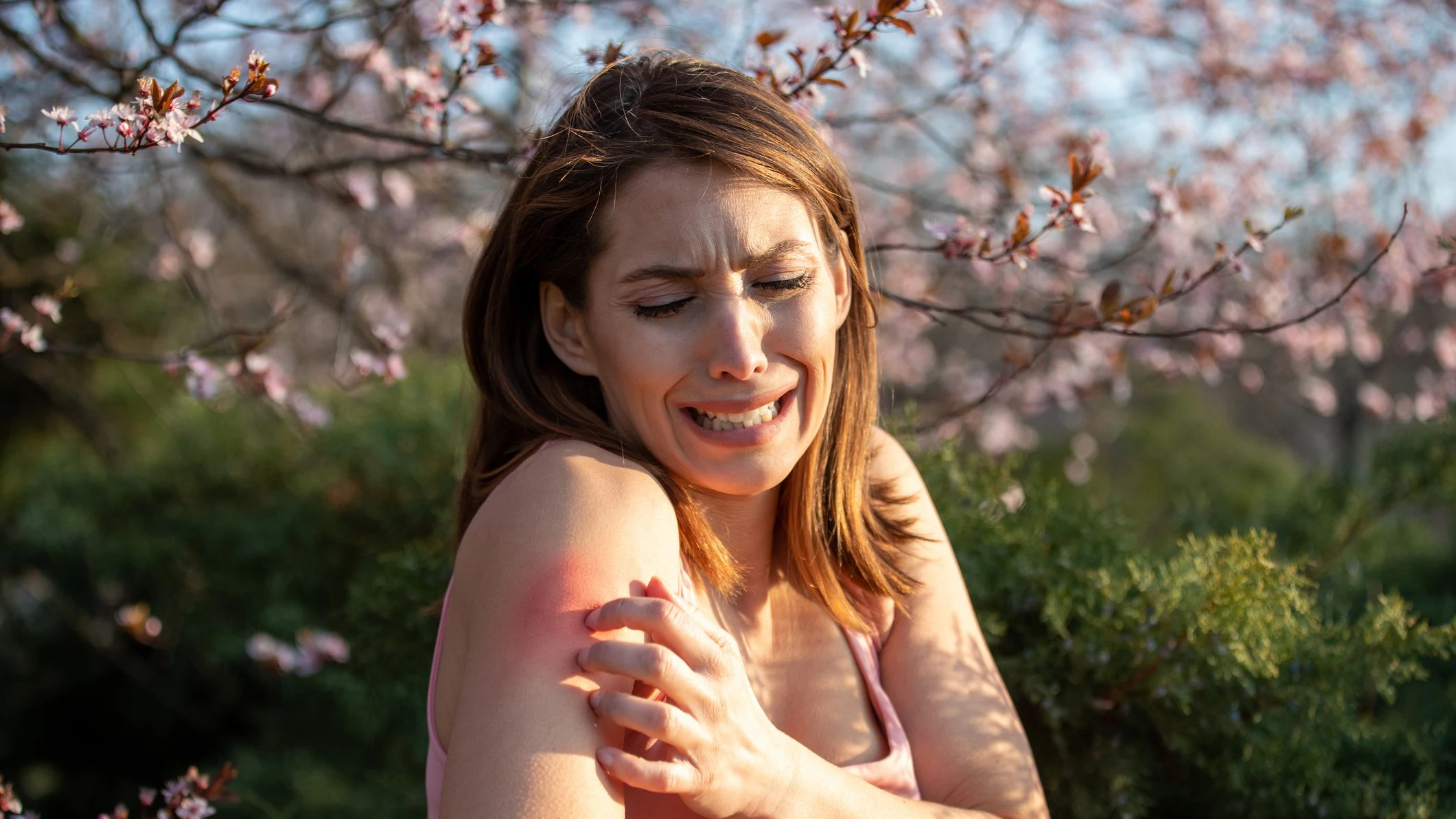 Pretty young woman scratching arm beside blooming tree in park in spring. Redness and itchy skin as allergic reaction