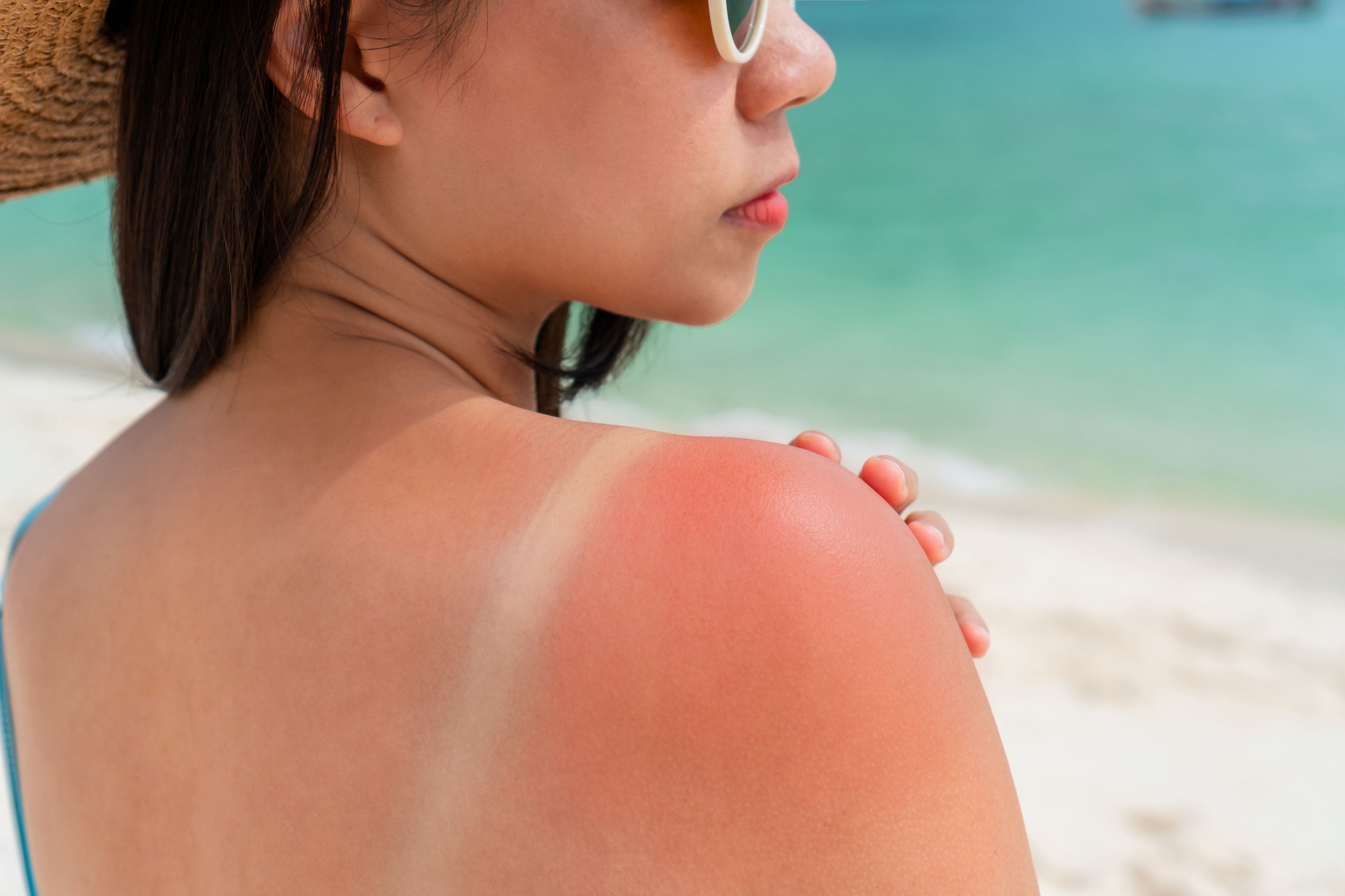 Viele Menschen schützen sich zu wenig vor Sonnenbrand.