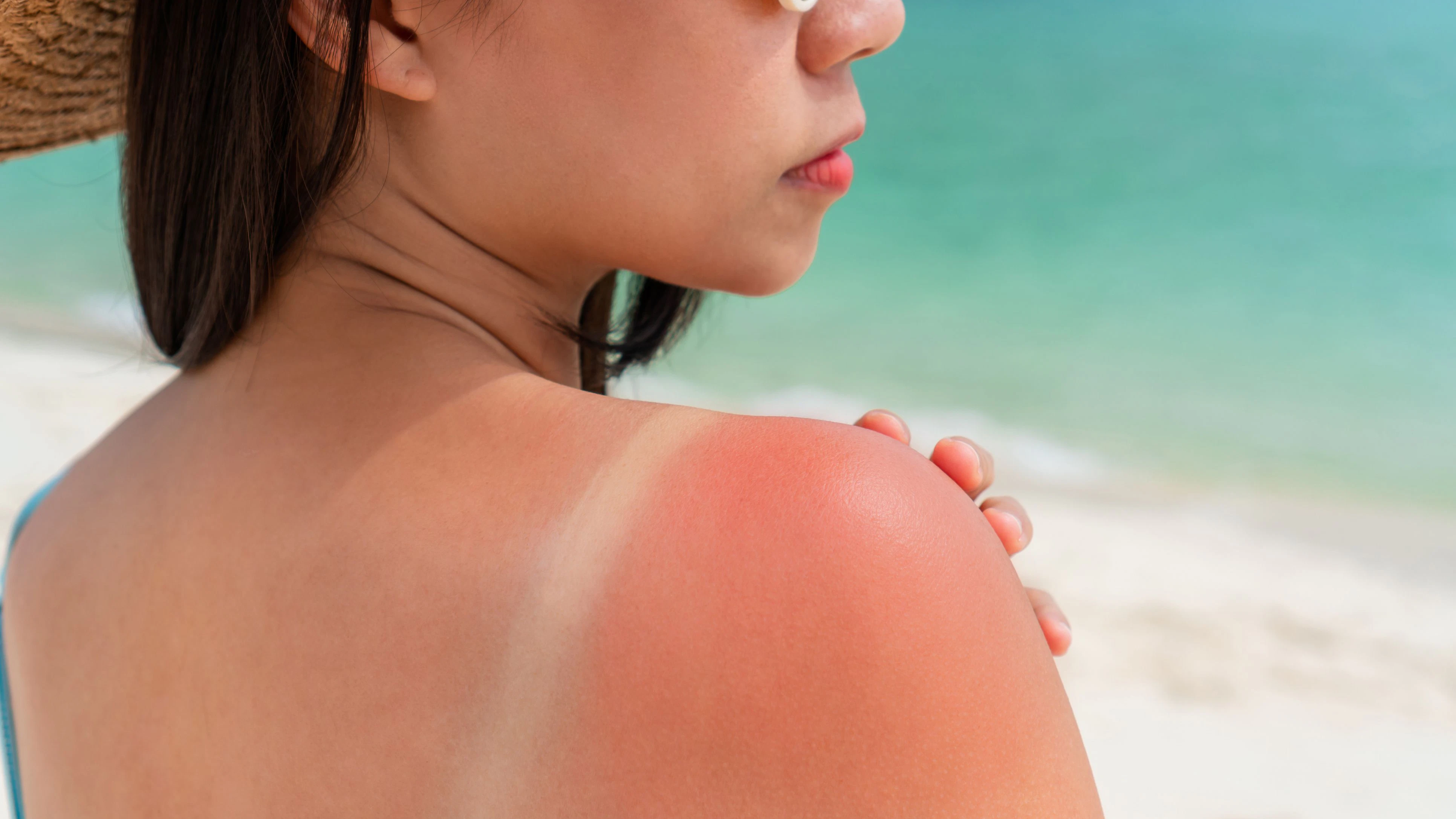 Sonnenbrand 