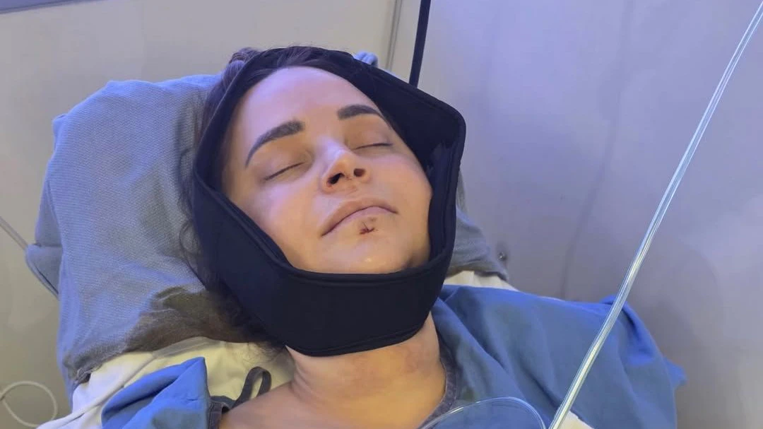YouTube-Star Rosanna Pansino zertrümmert sich Kiefer und Zähne.