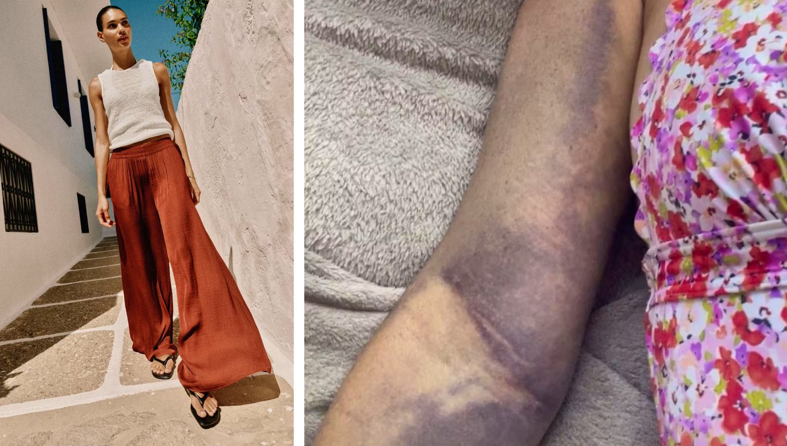 Heute.at - Knochenbrüche wegen Hose – doch Zara ist es egal