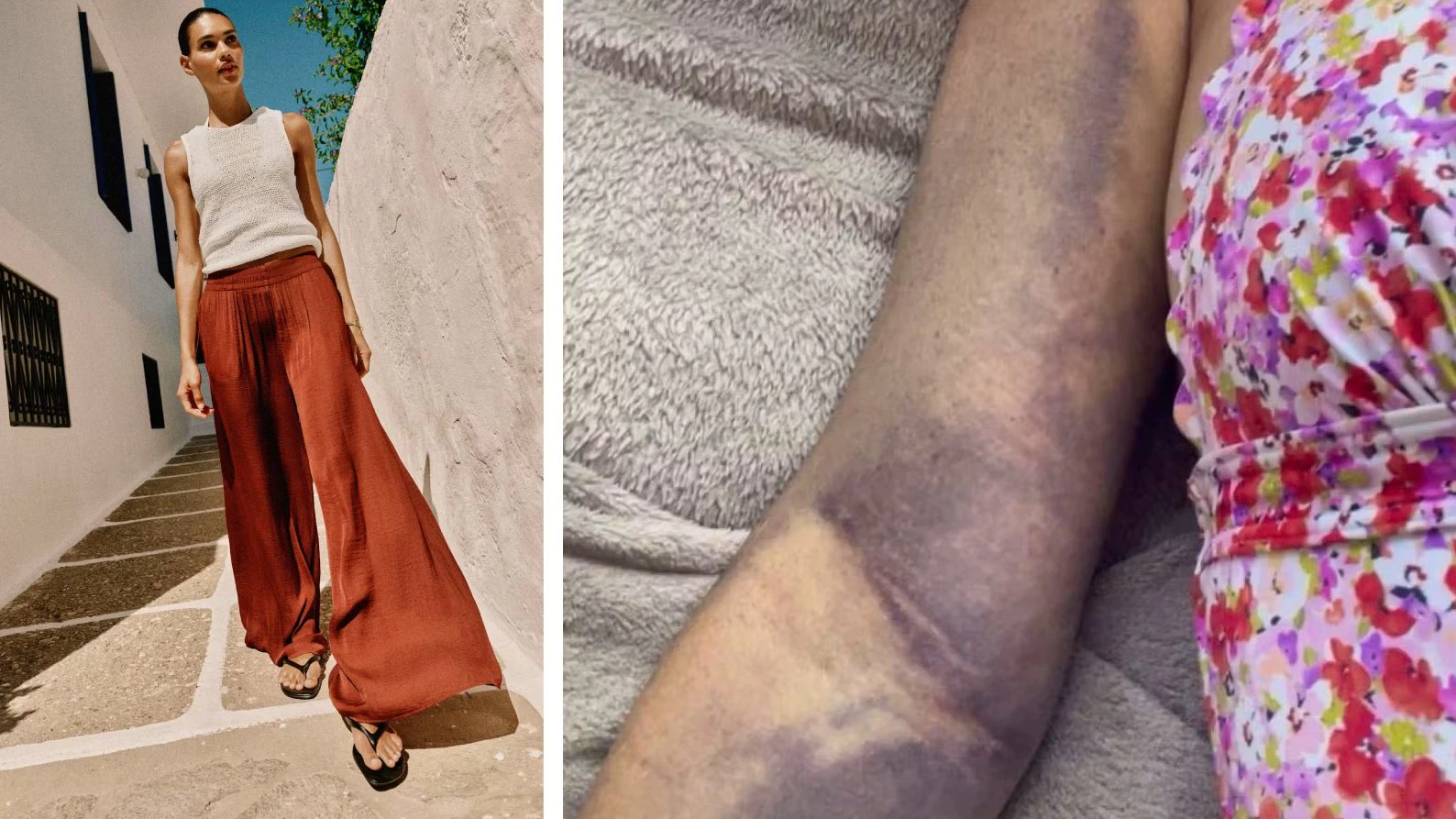 Heute.at - Knochenbrüche wegen Hose – doch Zara ist es egal