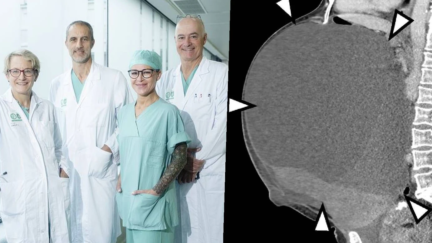 Heute.at - 18 Kilo schwer – Steirerin wurde Riesen-Tumor entfernt