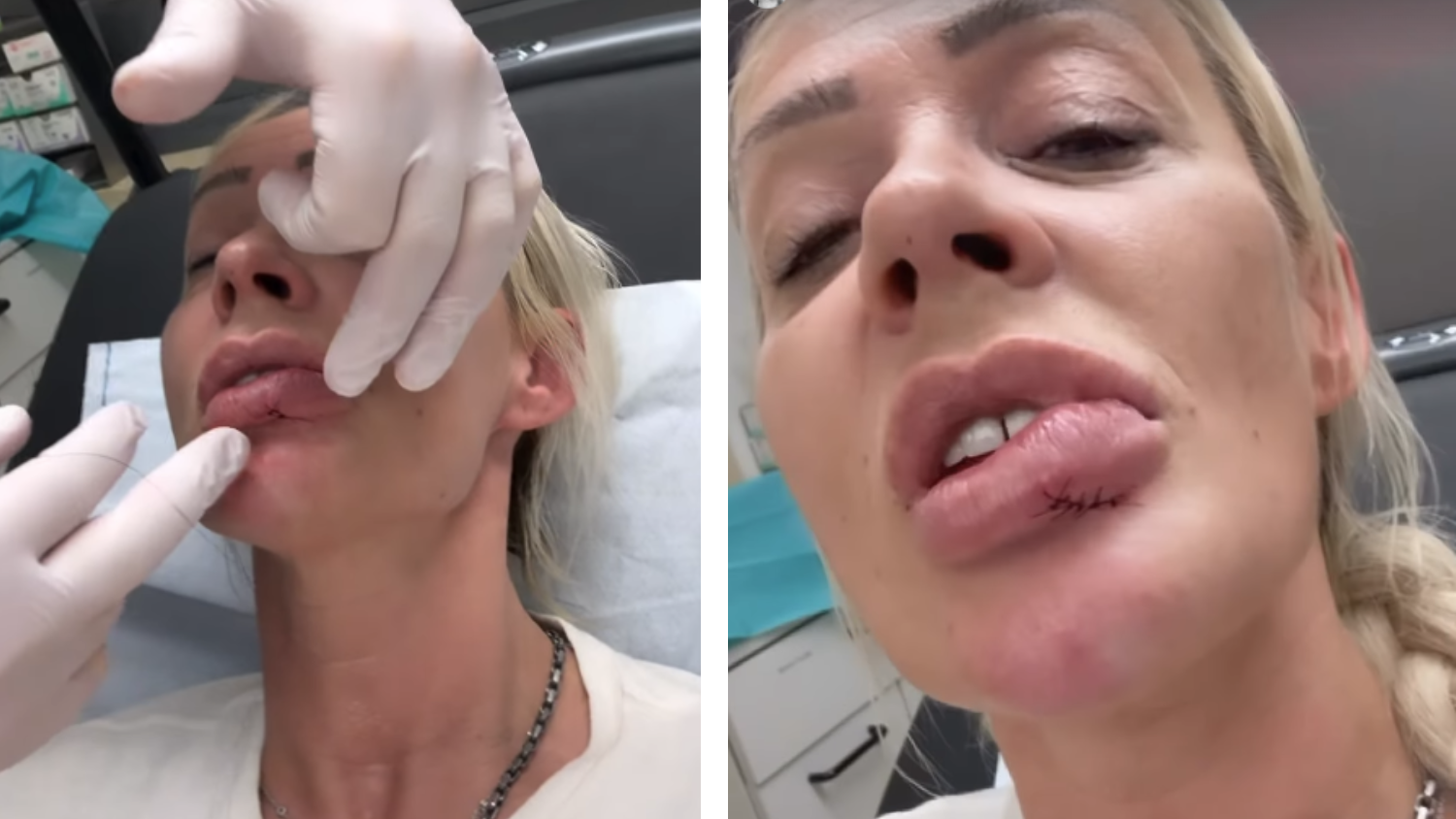 Cora Schumacher musste mit sechs Stichen genäht werden.
