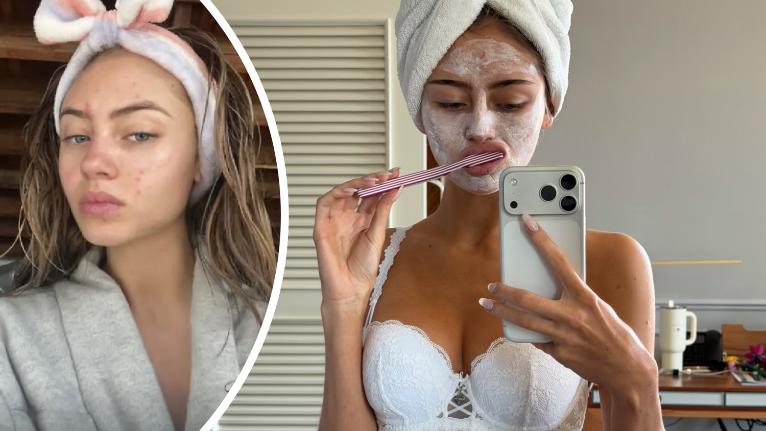 Leni Klum postet auf Instagram bewusst auch Bilder mit unreiner Haut.