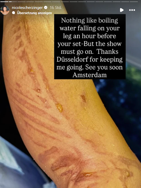 „Nichts ist schlimmer, als wenn einem eine Stunde vor dem Auftritt kochendes Wasser über das Bein tropft – aber die Show muss weitergehen“, schrieb Nicole Scherzinger am Sonntag in ihrer Instagram-Story.